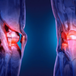 Dangers of Delaying Knee Replacement Surgery