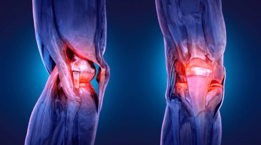 Dangers of Delaying Knee Replacement Surgery