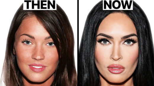 Megan Fox - Before and After Plastic Surgery