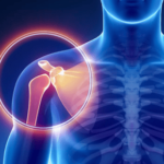 Workers' Compensation for Shoulder Injury Requiring Surgery - What You Need to Know