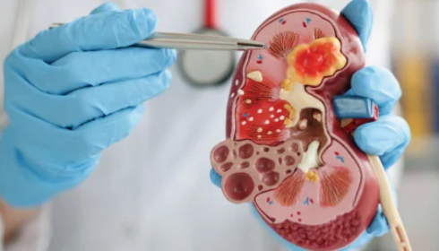 best nephrologist in Bangalore