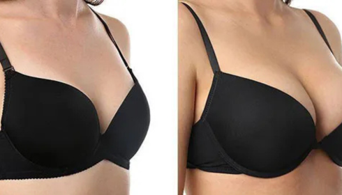 Breast Augmentation In Bangalore